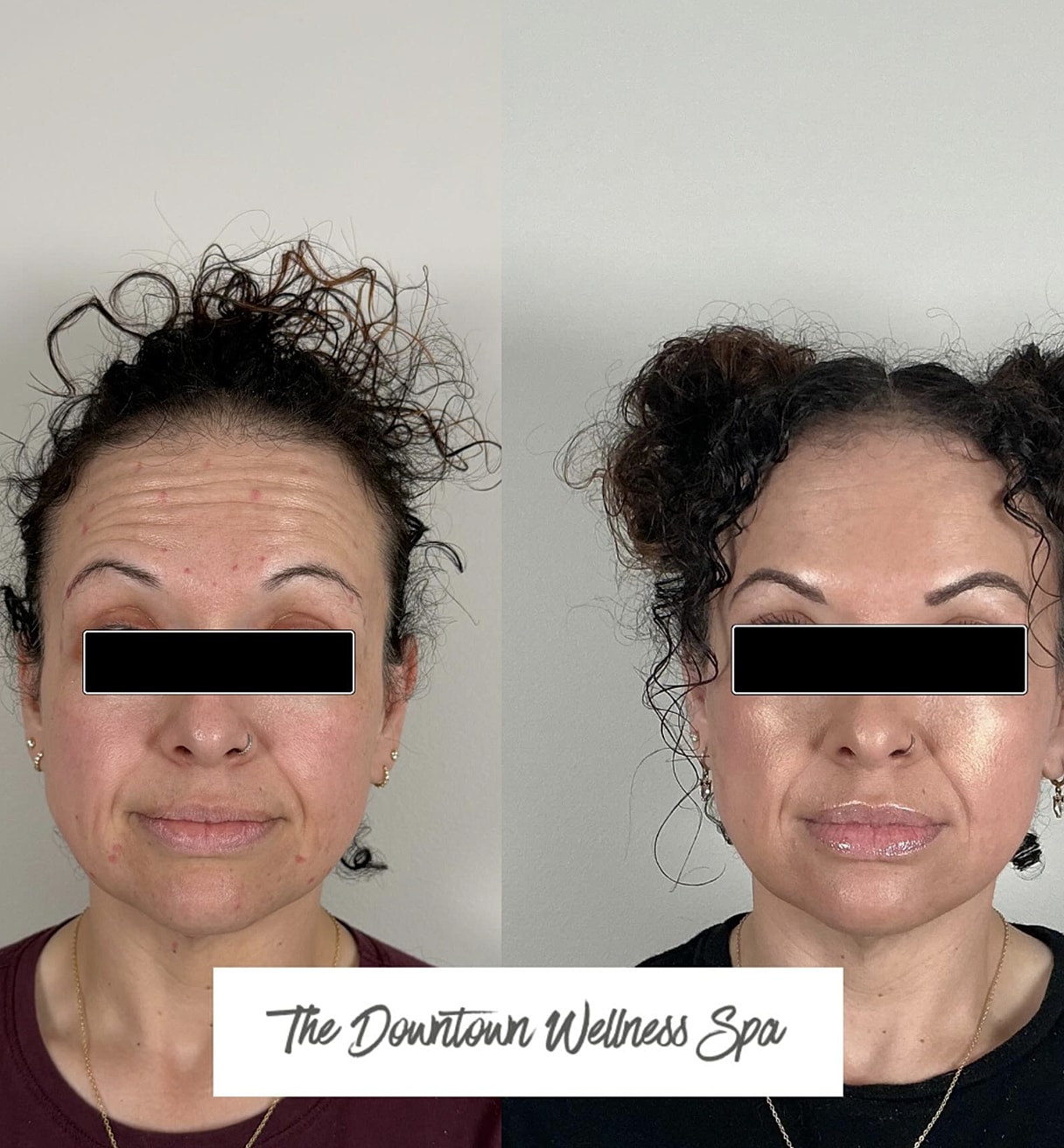 Before and after wellness spa treatment comparison.