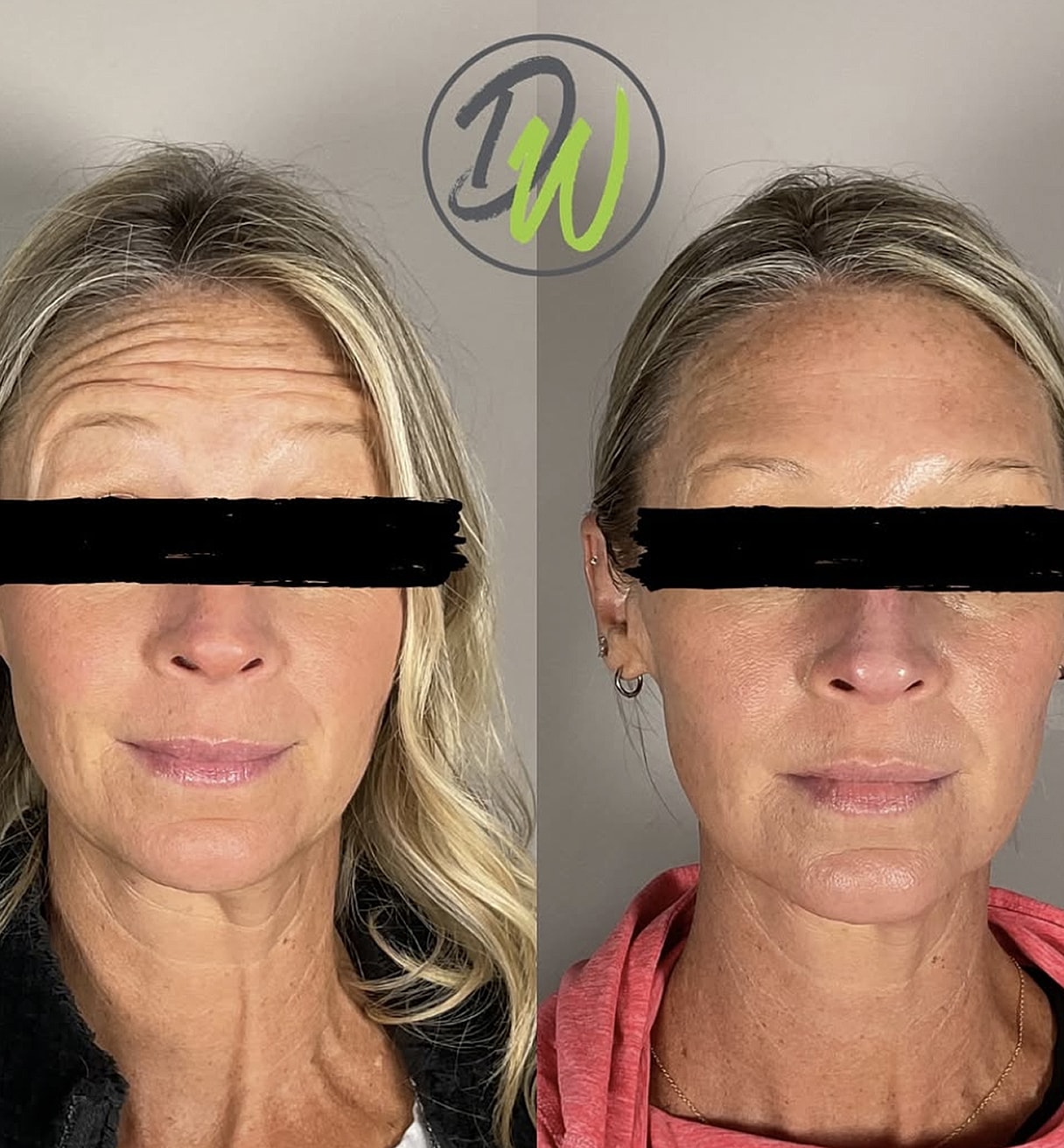 Before and after skin treatment comparison.