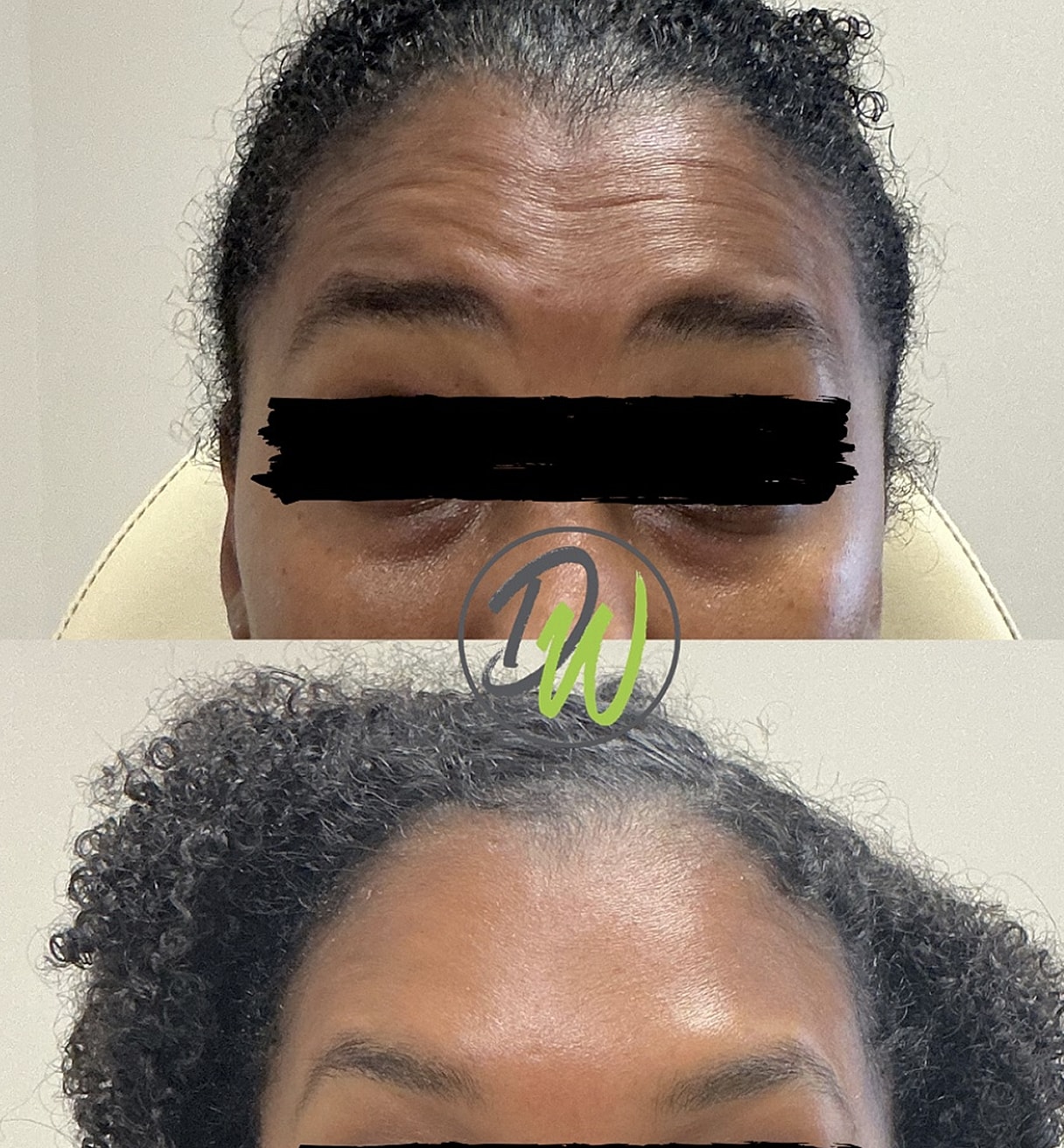 Before and after skin treatment comparison.