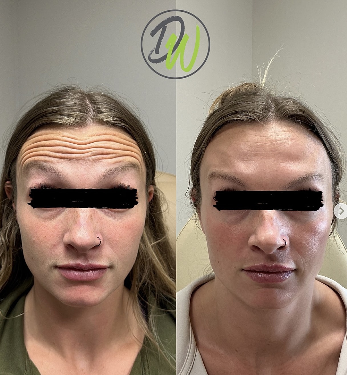 Before and after facial treatment comparison.