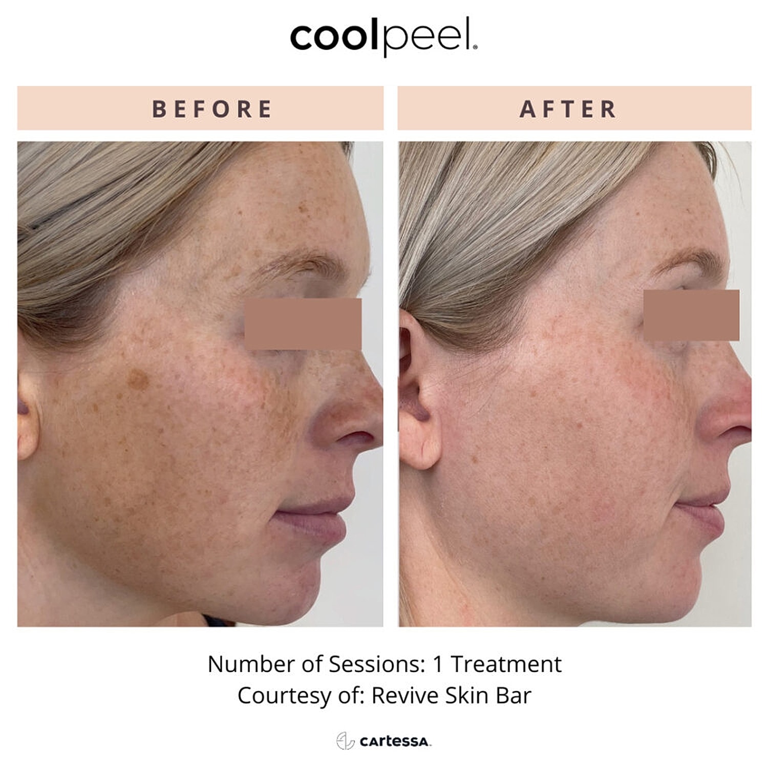 Cool Peel treatment before and after comparison