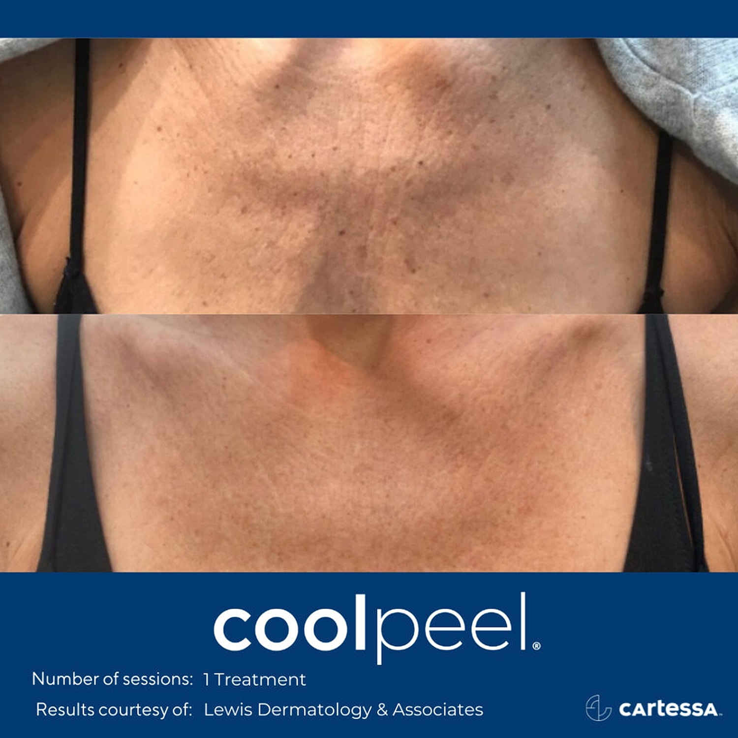 Before and after CoolPeel treatment results.