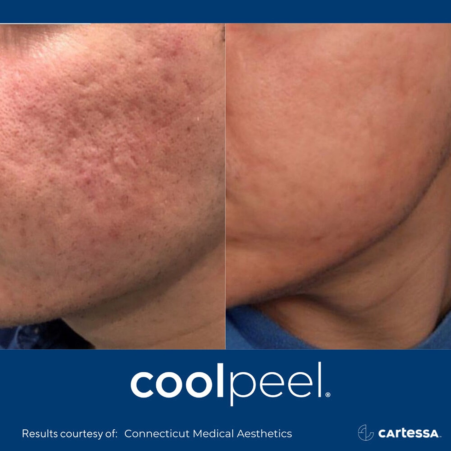 Before-and-after Cool Peel skin treatment comparison.