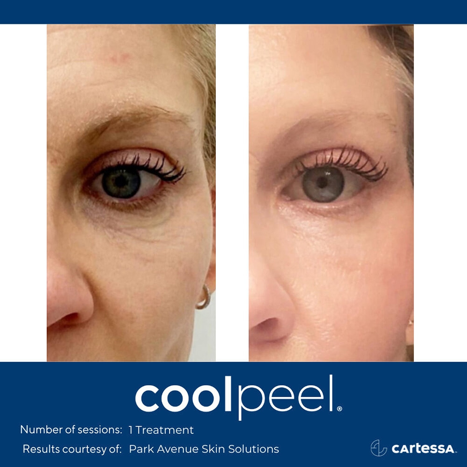 Before and after CoolPeBefore and after CoolPeel treatment results