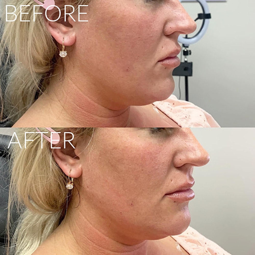 Before and after cosmetic treatment comparison.