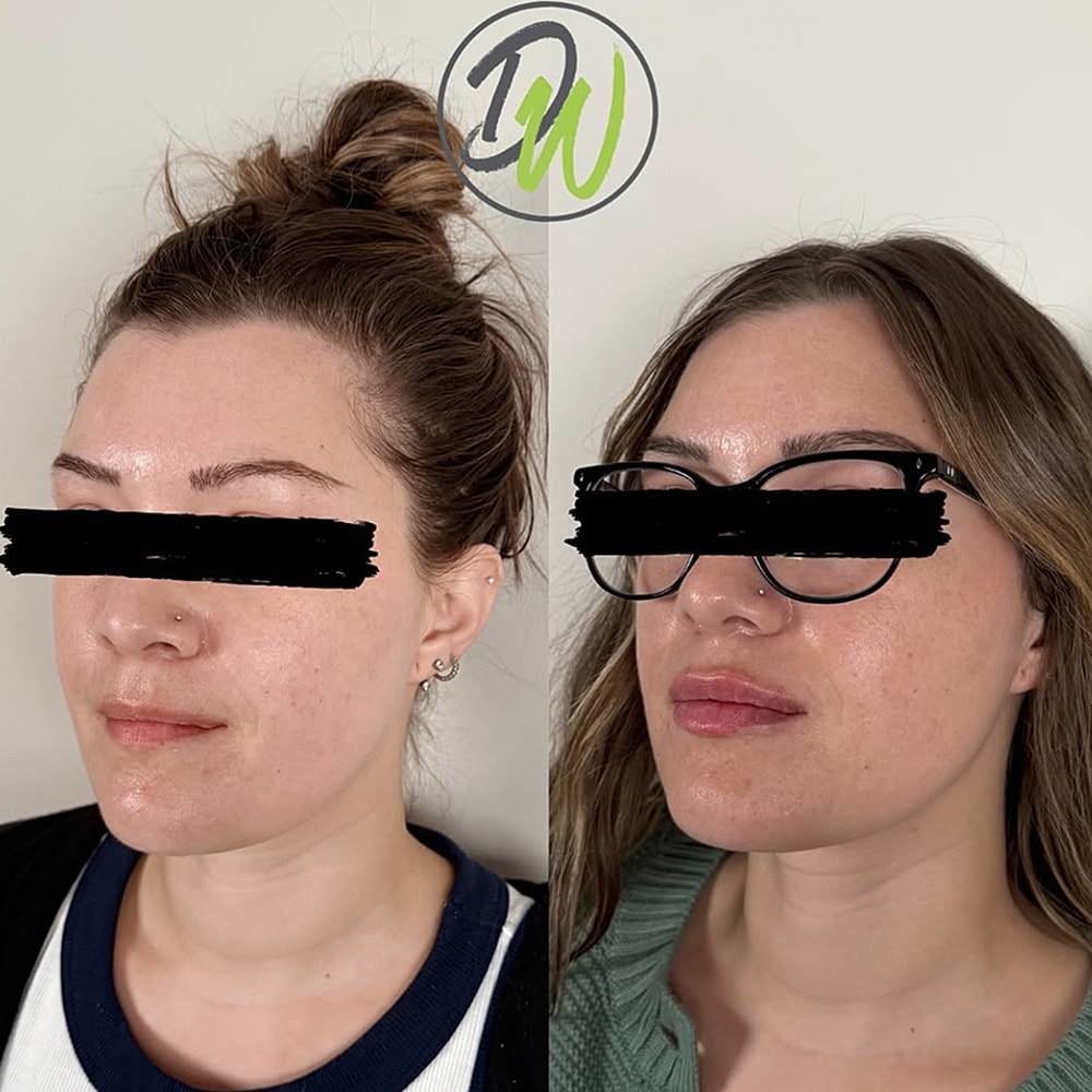Before and after skincare treatment comparison.