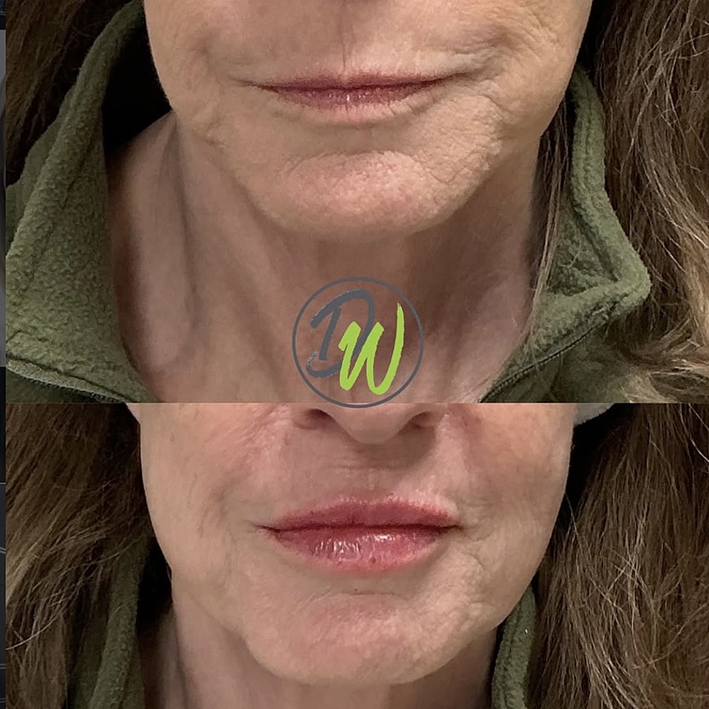 Before and after facial treatment results.