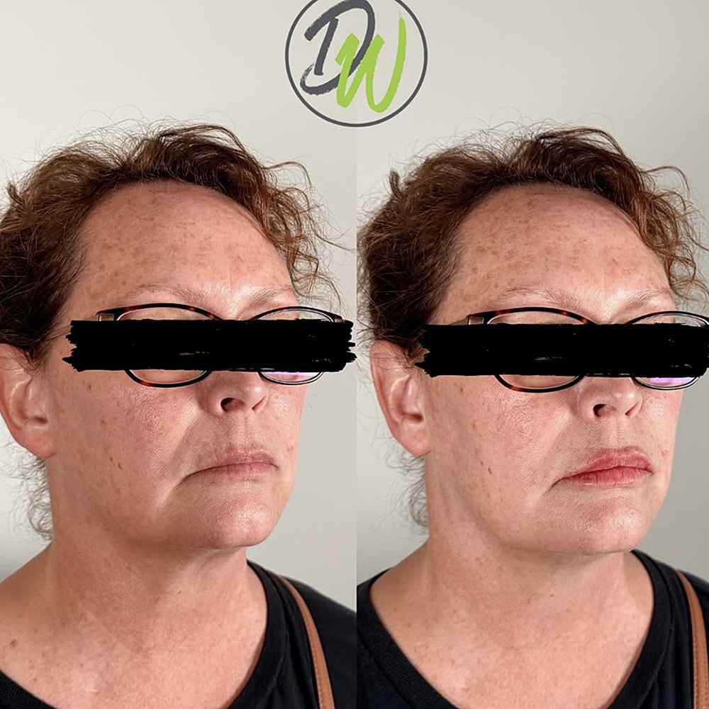 Before and after facial treatment comparison.