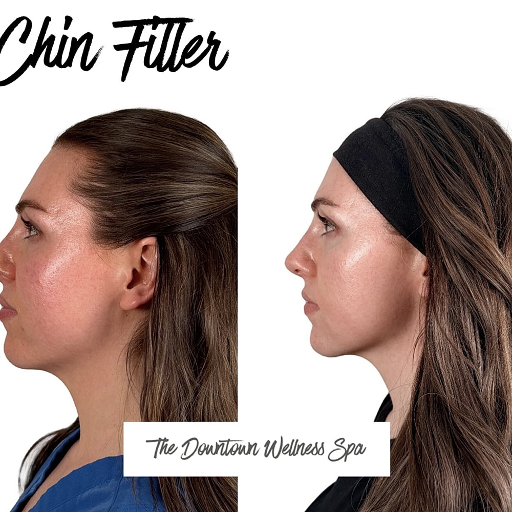 Chin filler before and after comparison image.