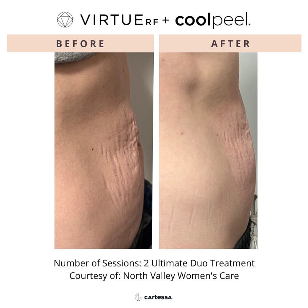 Stretch marks treatment before and after results