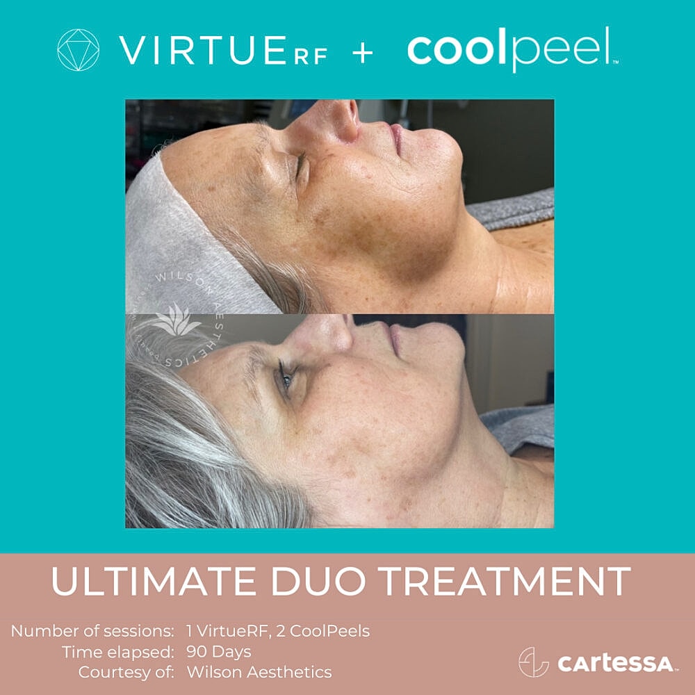 Before and after skin treatment comparison results.