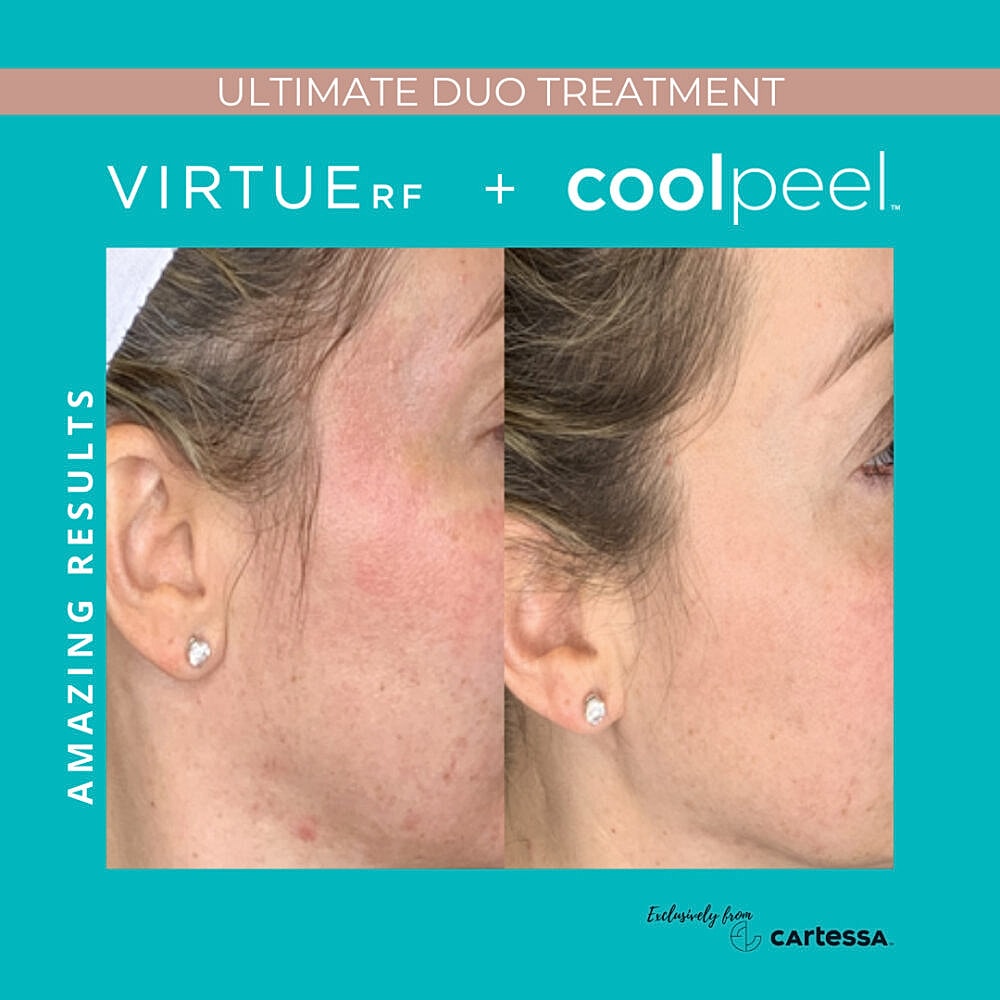 Skin treatment before and after results comparison.