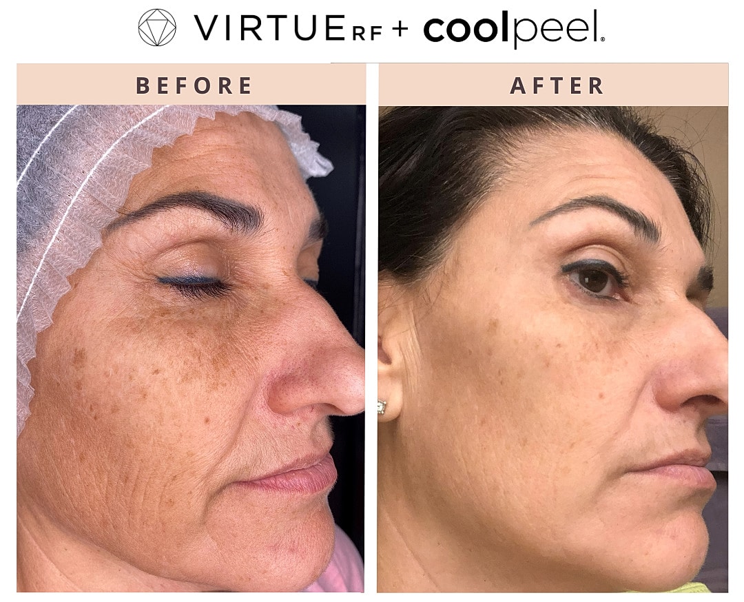 Skin rejuvenation before and after treatment.