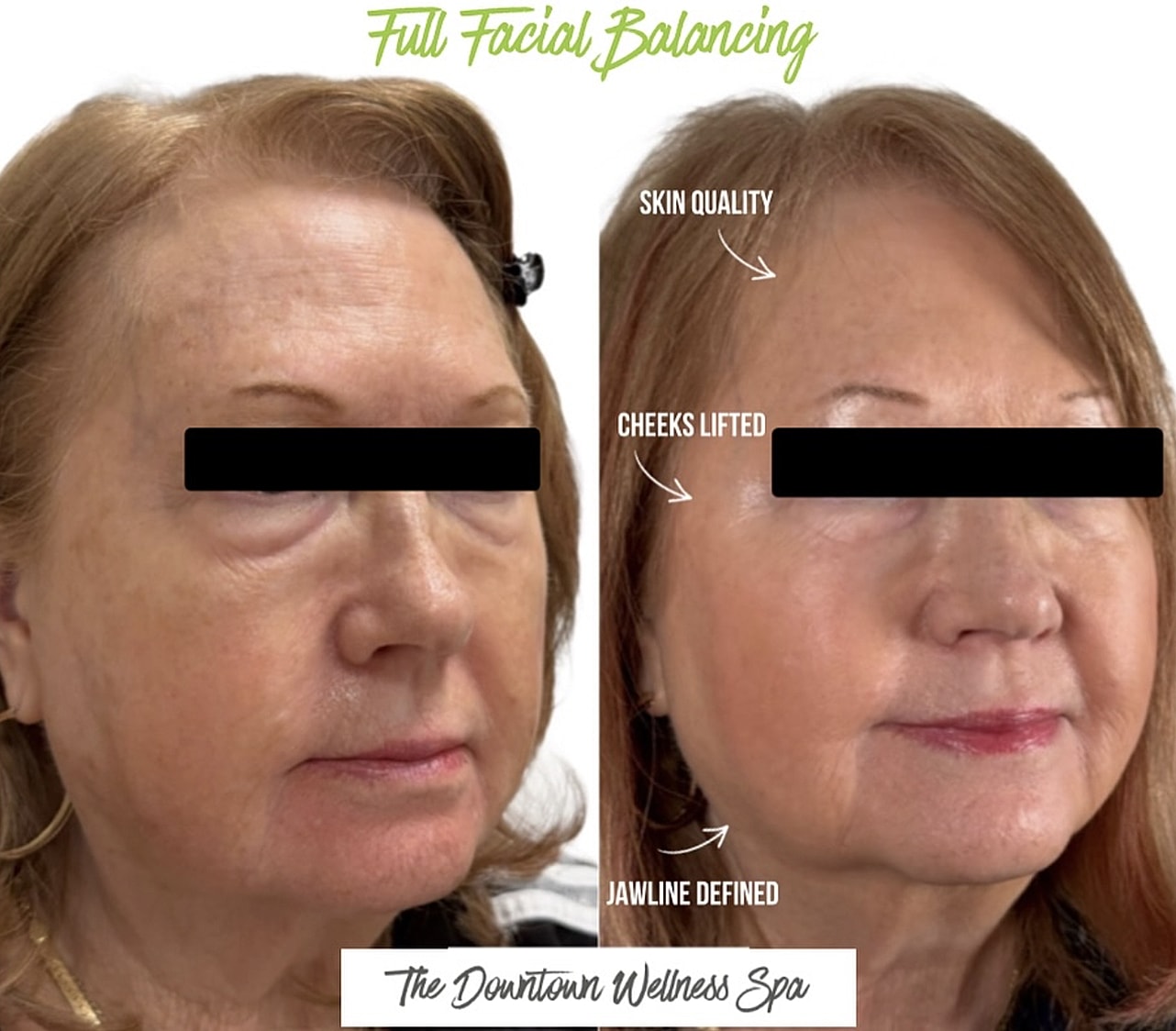 Before and after facial balancing transformation.