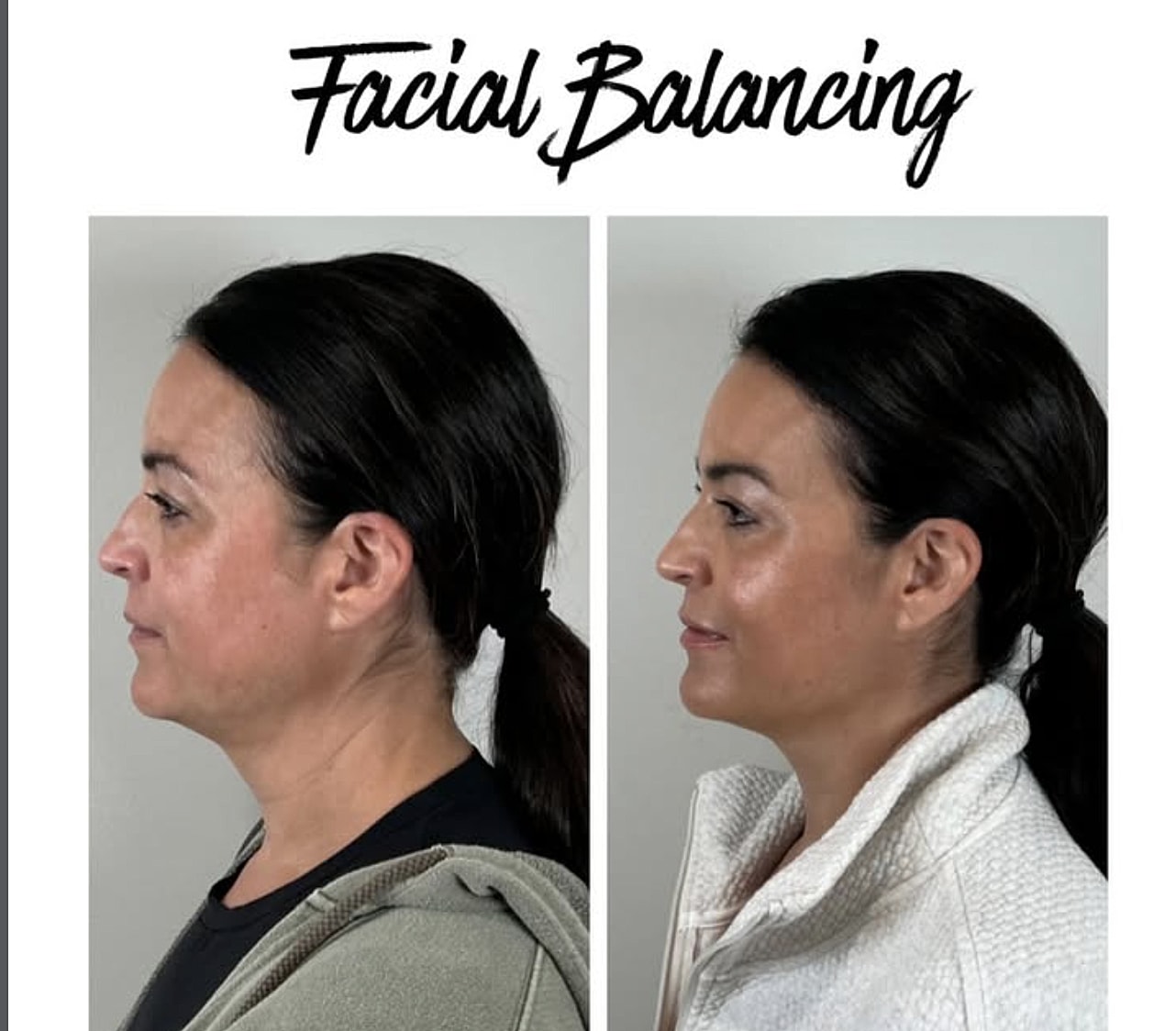 Before and after facial balancing treatment.