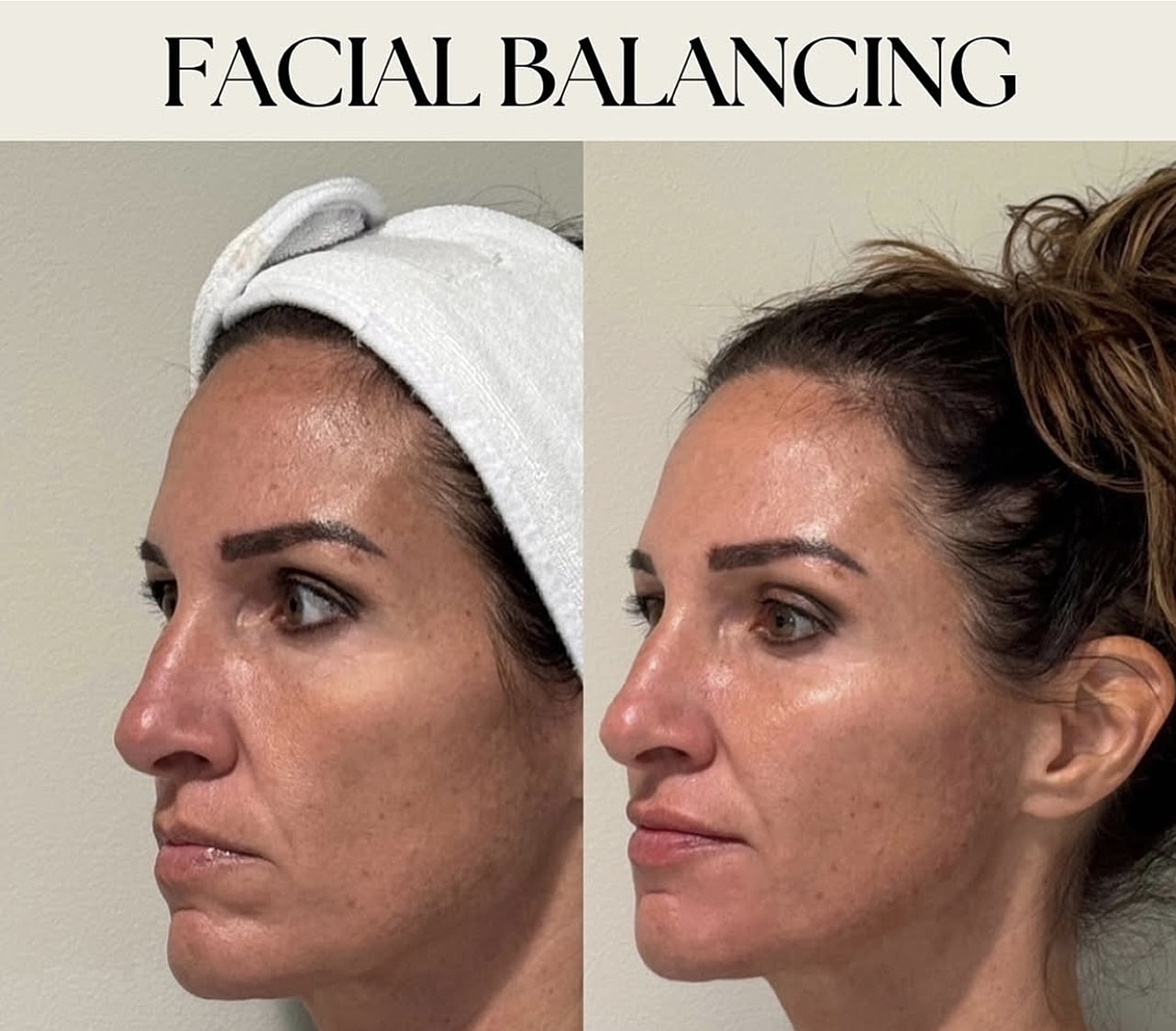 Before and after facial balancing treatment.