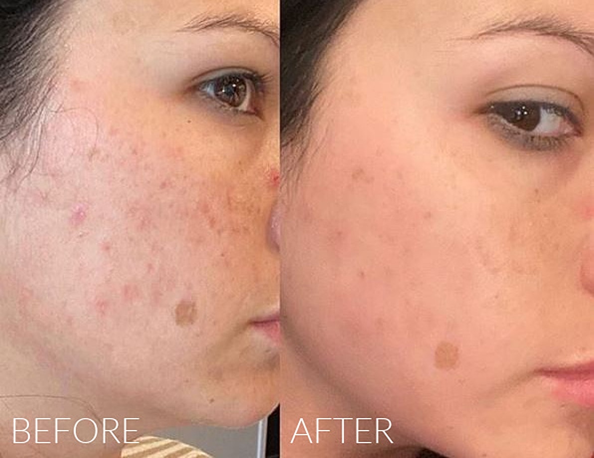 Skin improvement before and after treatment.