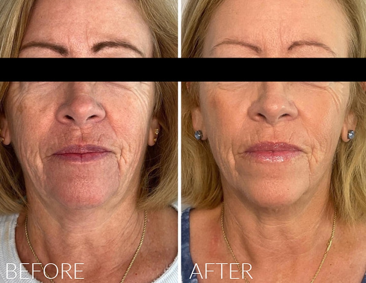 Before and after facial rejuvenation treatment comparison.Before and after facial rejuvenation treatmentBefore and after facial rejuvenation treatment.