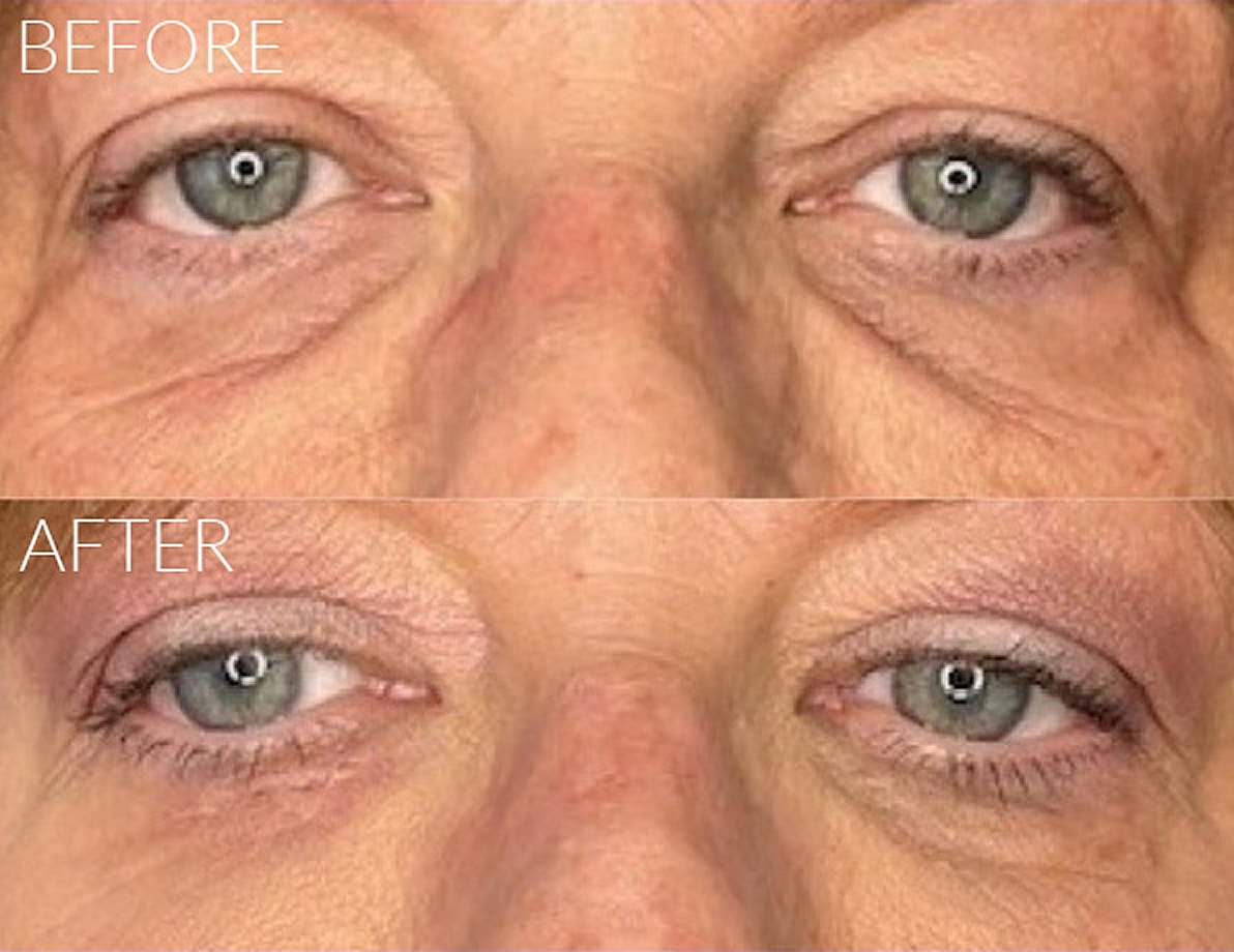 Before and after eye rejuvenation comparisonBefore and after eye rejuvenation comparison