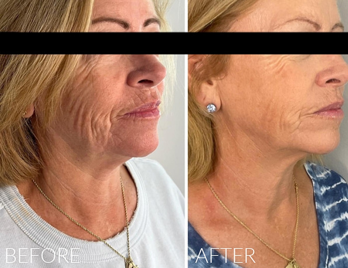 Before and after facial rejuvenation treatment