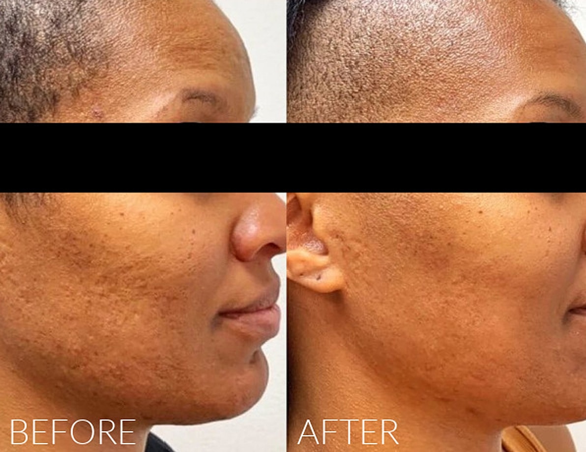 Skin treatment before and after results comparison.