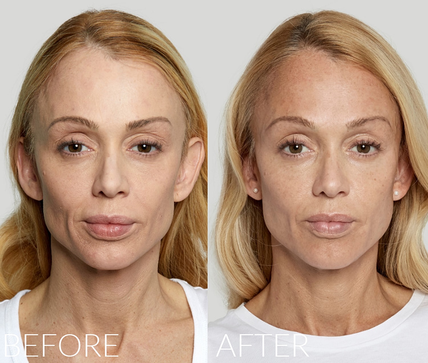 Before and after skincare treatment comparison.