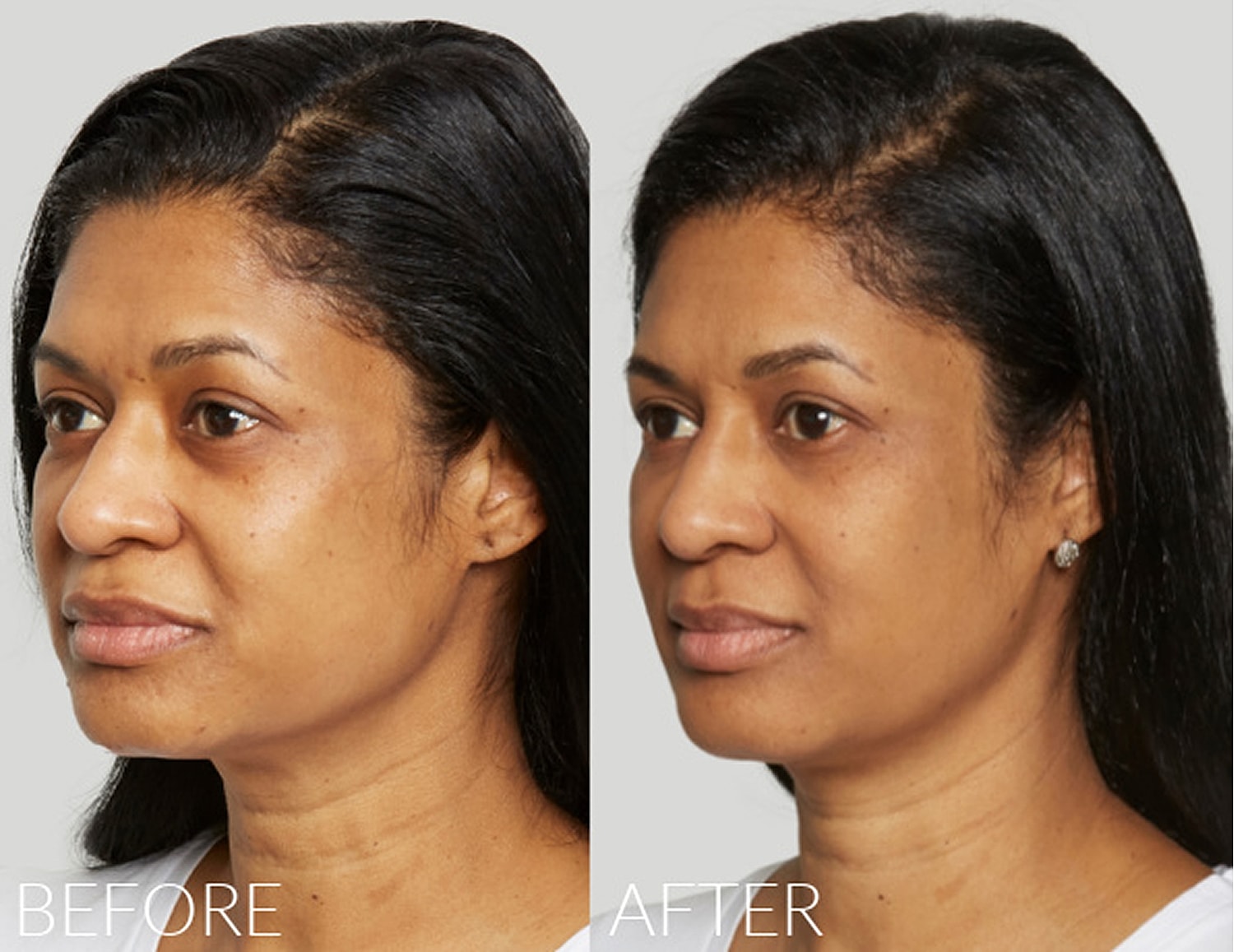 Before and after skincare results.