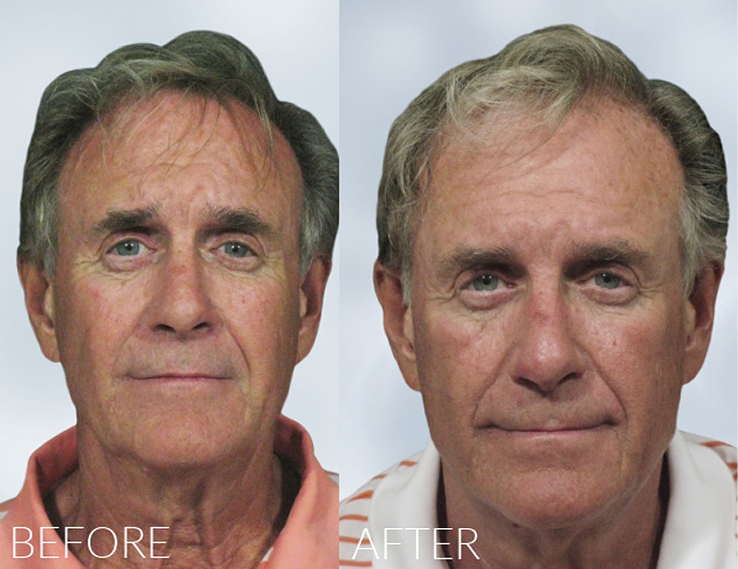 Before and after facial rejuvenation comparison.