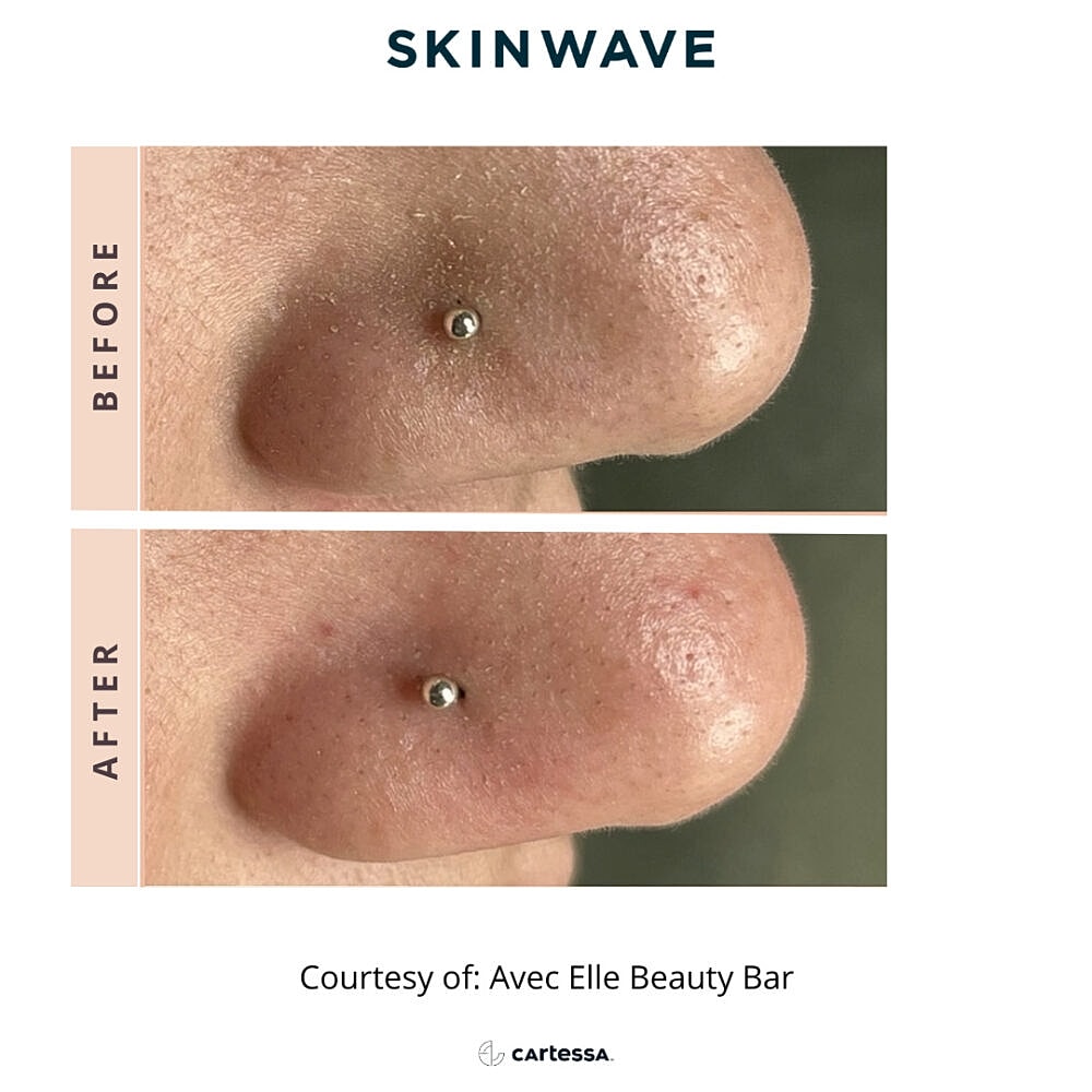 Nose piercing before and after treatment comparison.