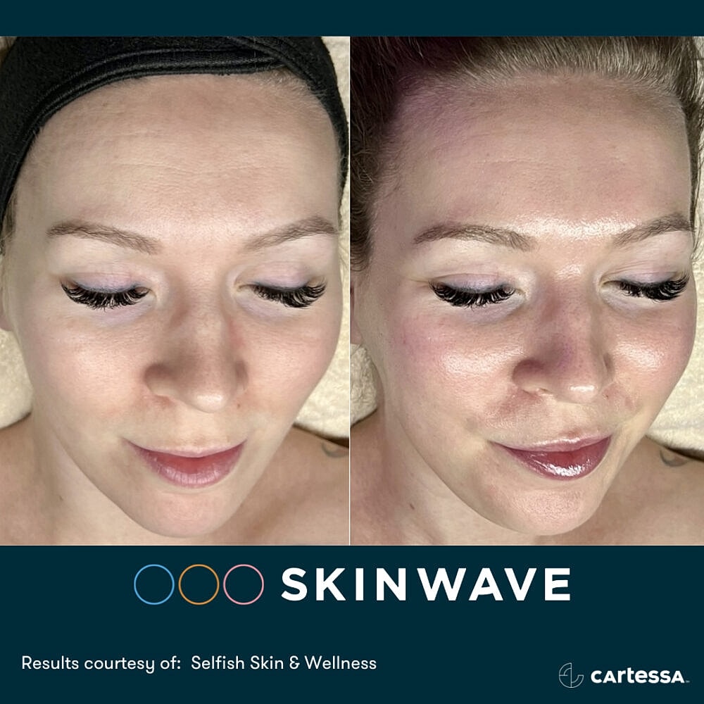 Before and after Skinwave treatment results