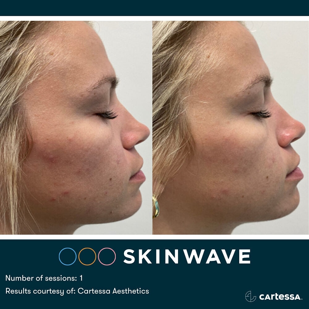 Before and after Skinwave treatment results