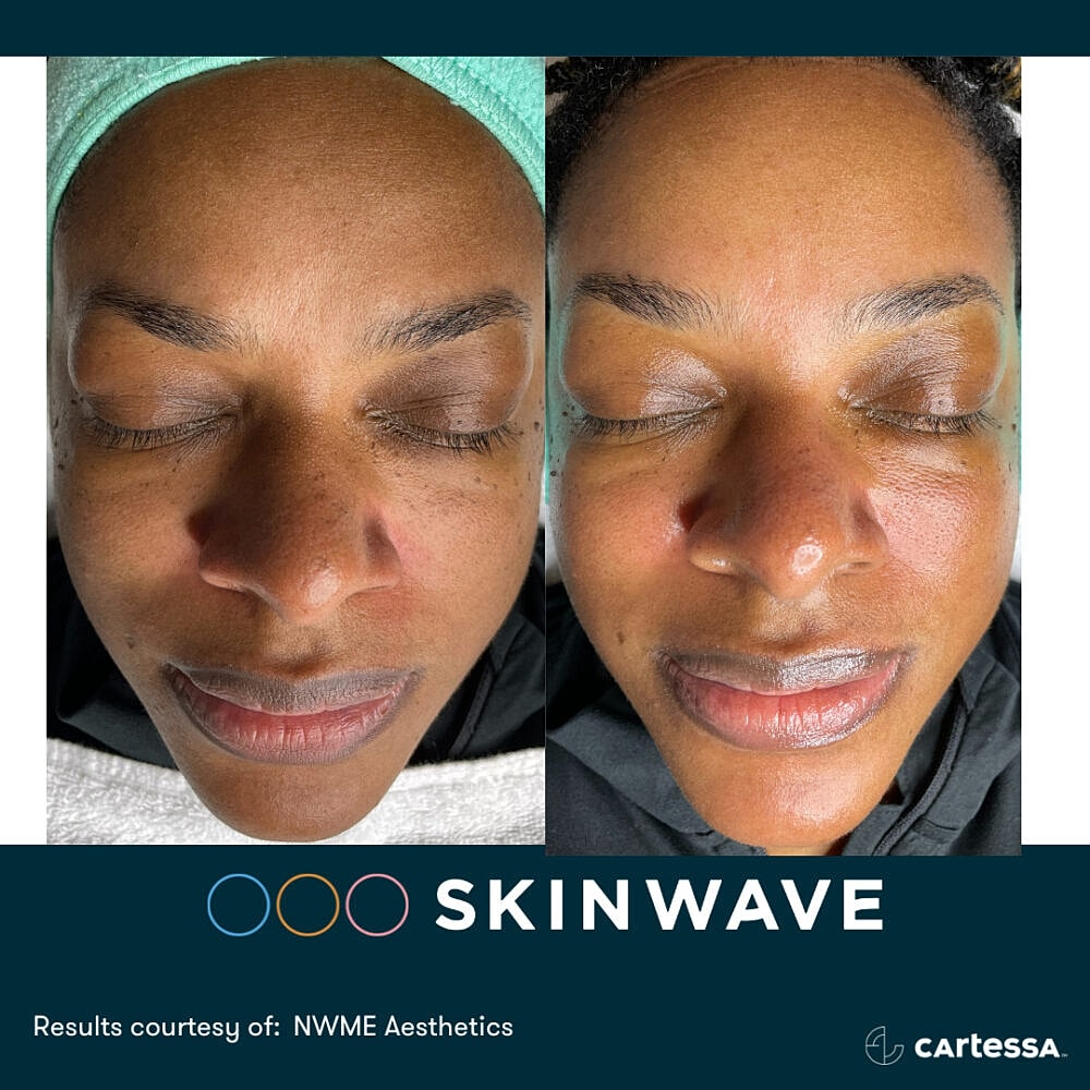 Before and after skin treatment results comparison.