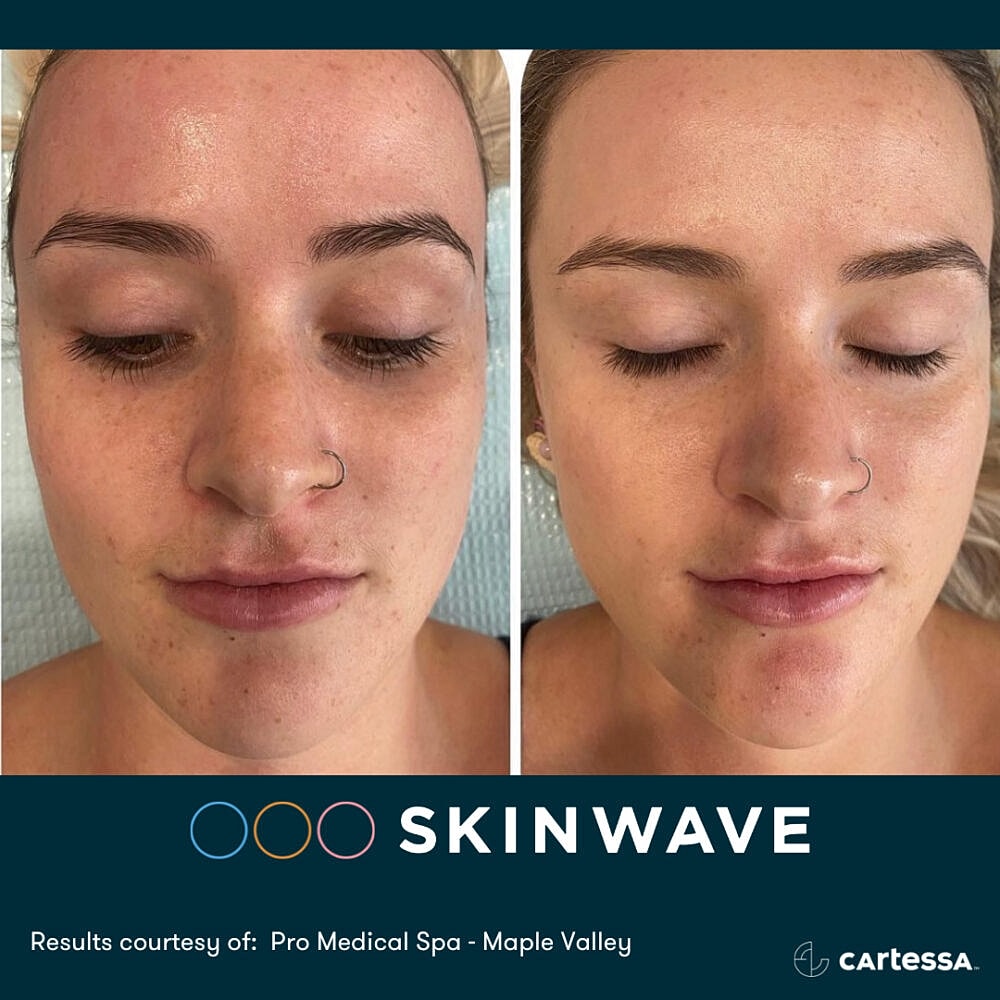 Skin rejuvenation results before and after treatment.