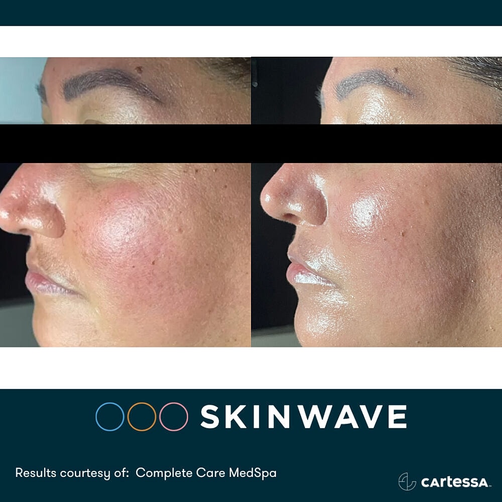 Before and after skin treatment results