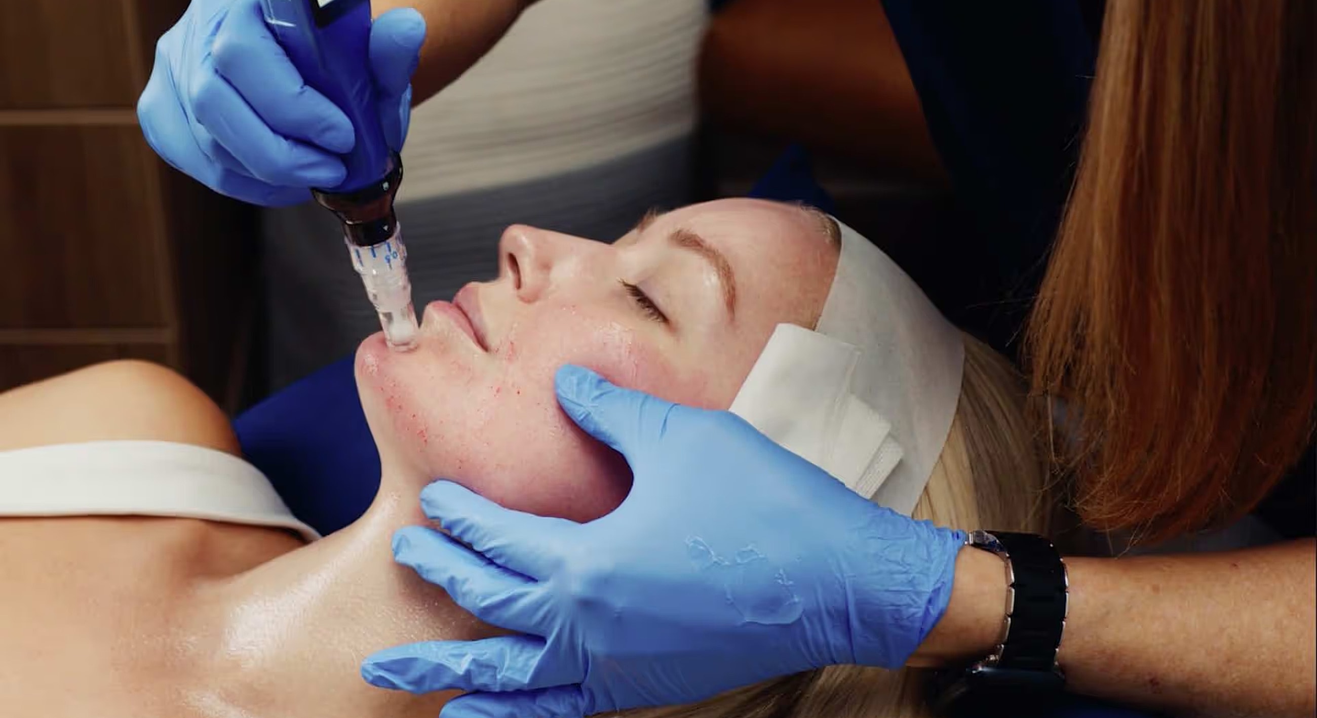 Microneedling treatment in progress on woman's face.